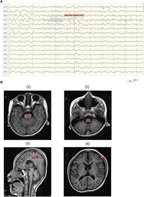 Novel compound heterozygous variants in the CSPP1 gene causes Joubert syndrome: case report and literature review of the CSPP1 gene’s pathogenic mechanism